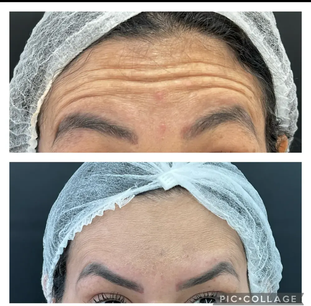 Antes e depois de toxina botulínica na testa — suavização das linhas de expressão