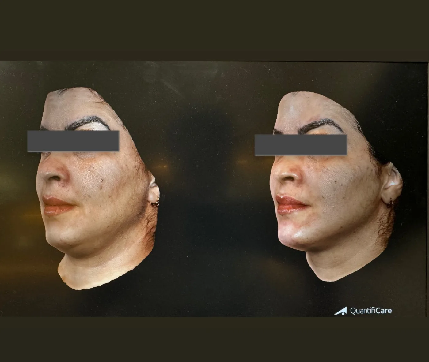 Antes e depois — definição do contorno mandibular e tratamento de bulldog