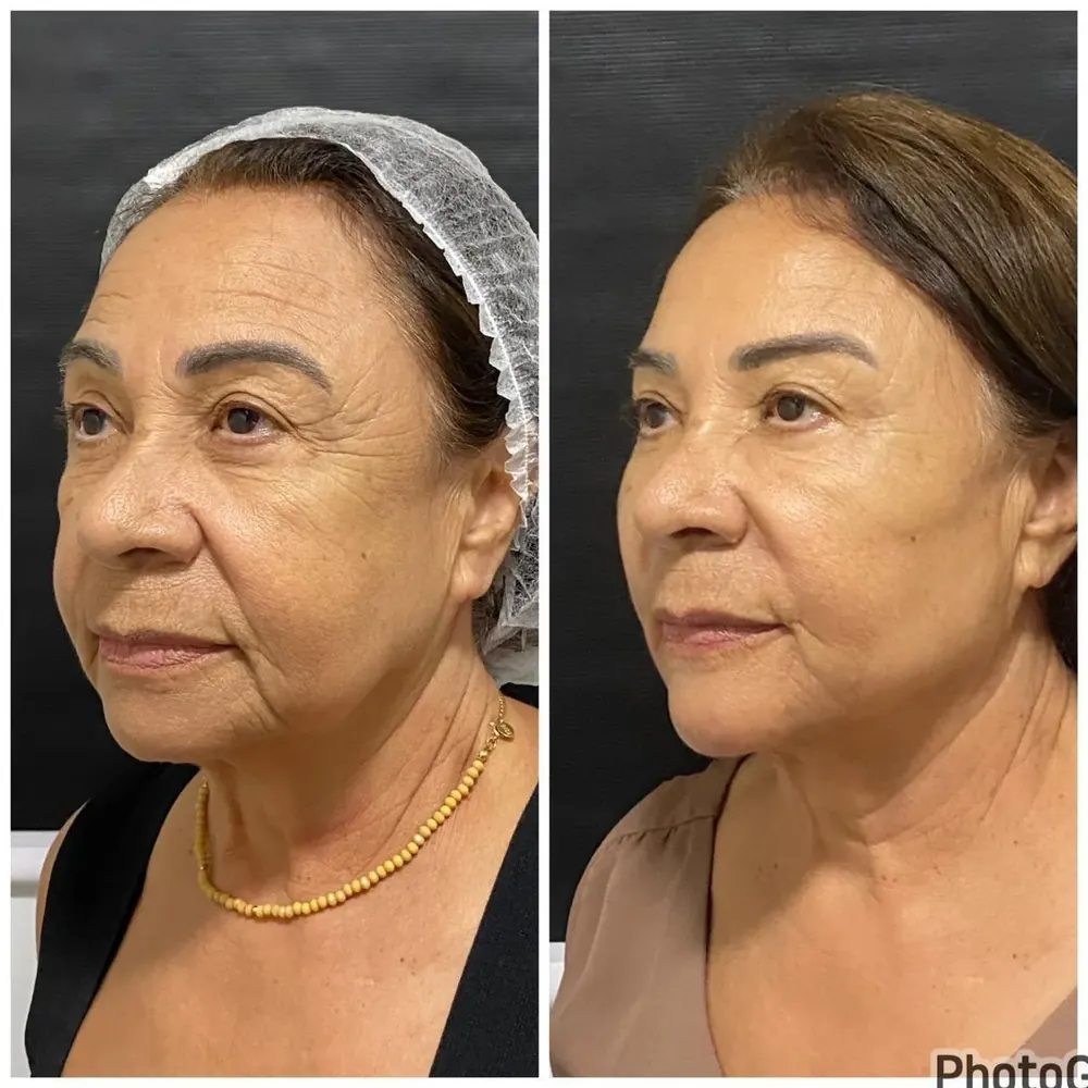 Antes e depois de contorno mandibular