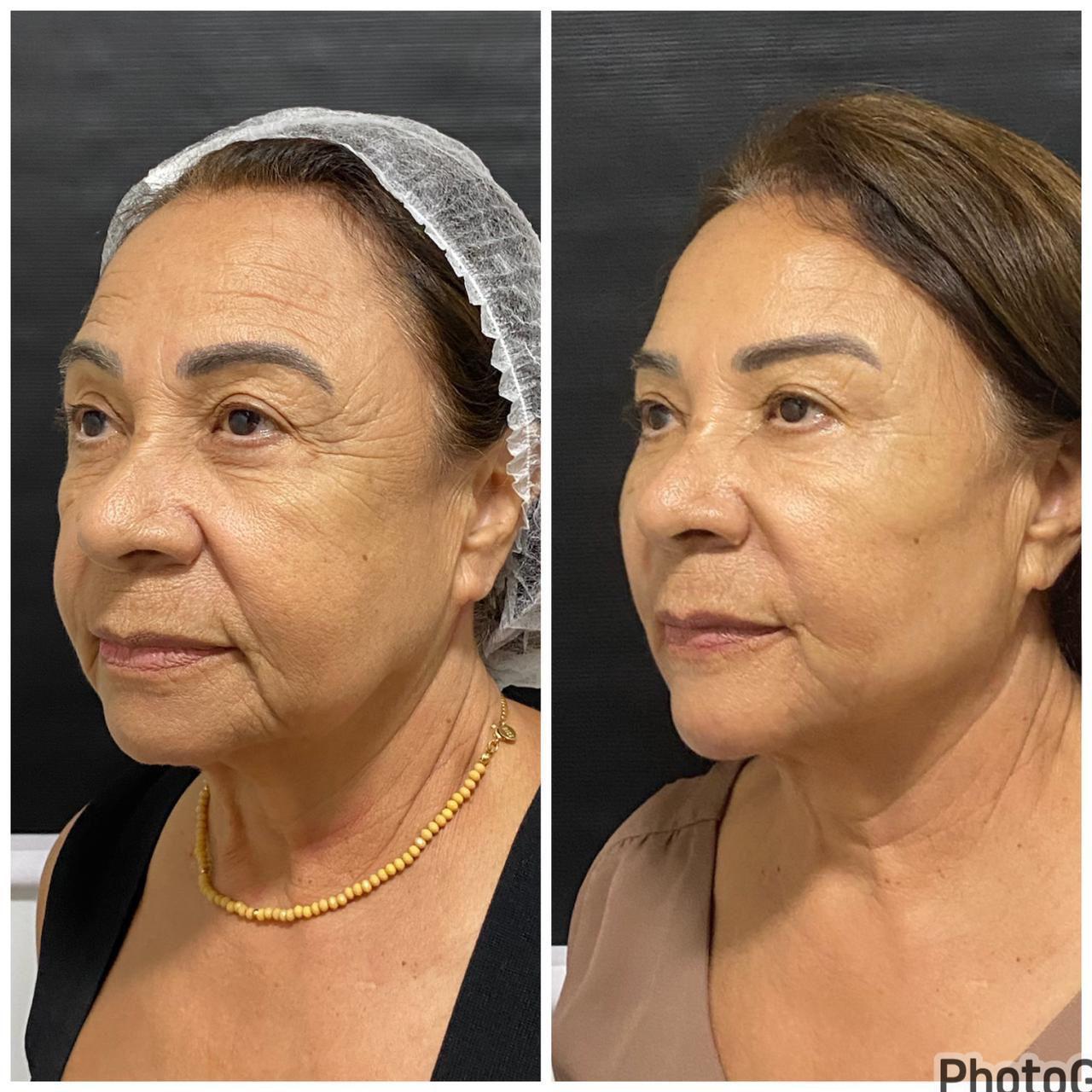 Antes e depois de contorno facial com harmonização pela Dra. Larissa Abreu