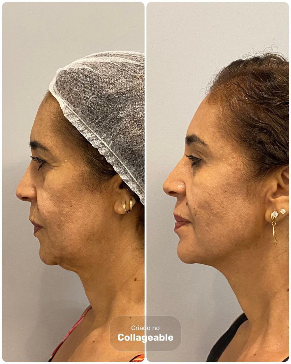 Antes e depois de contorno facial com fios de PDO pela Dra. Larissa Abreu