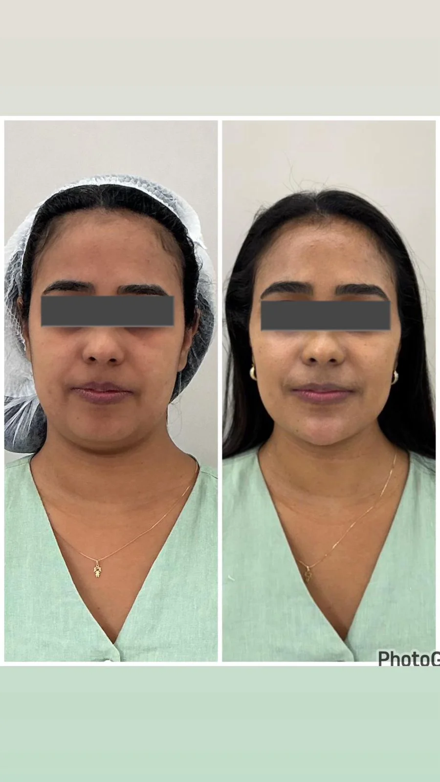 Antes e depois de harmonização facial — vista frontal