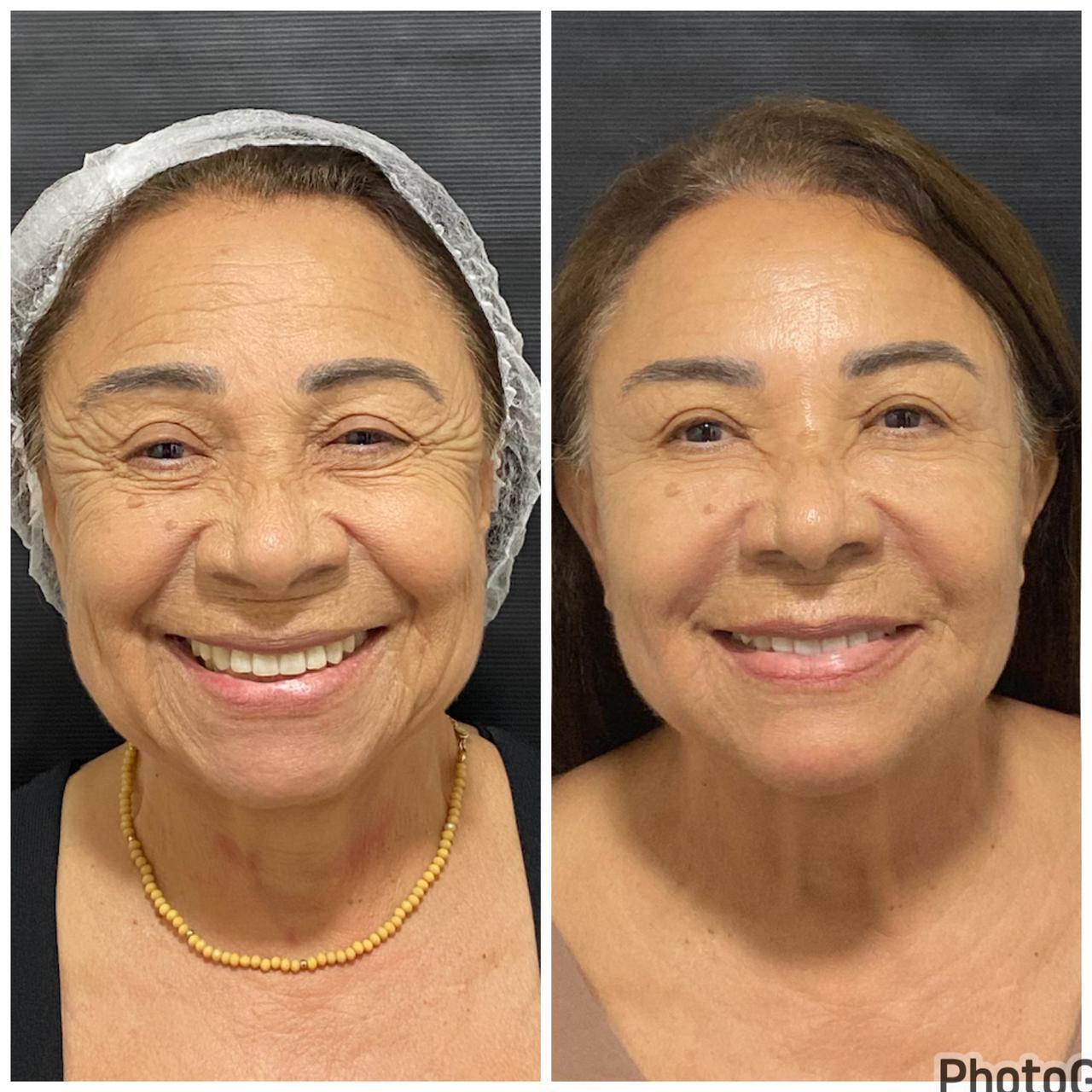 Antes e depois de harmonização facial feminina com a Dra. Larissa Abreu em Salvador