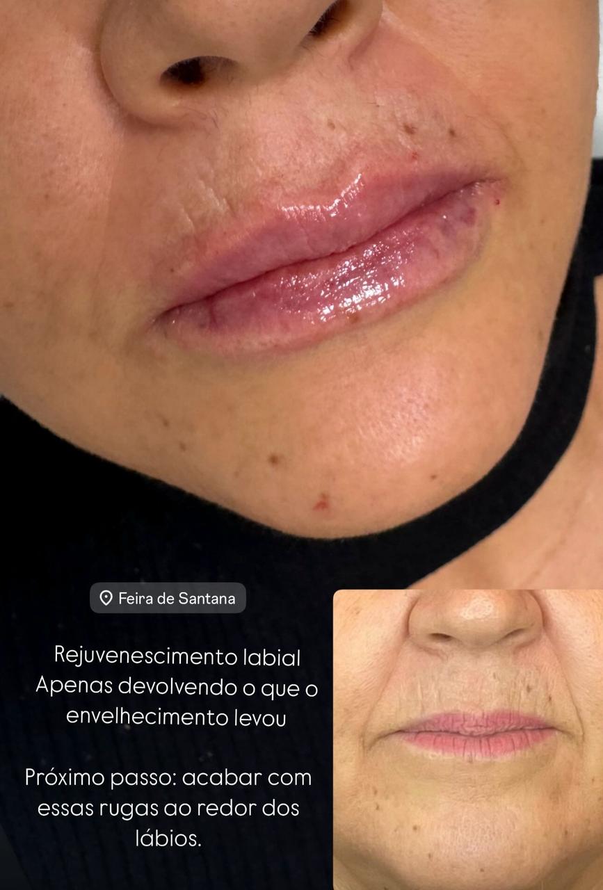 Antes e depois de preenchimento labial com ácido hialurônico pela Dra. Larissa Abreu em Salvador