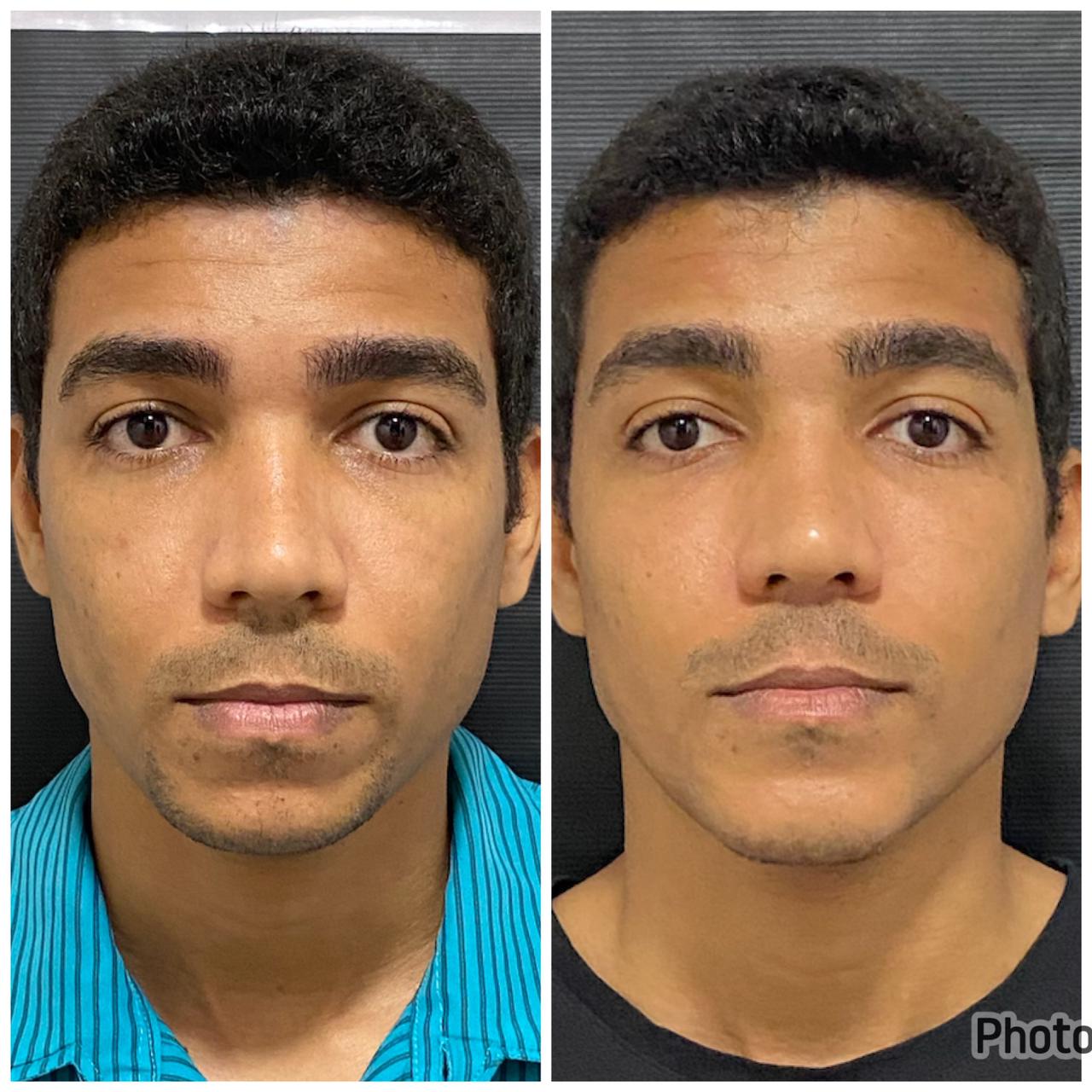 Antes e depois de harmonização facial masculina com a Dra. Larissa Abreu