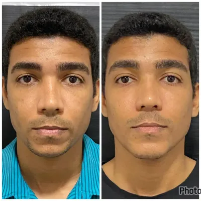 Antes e depois de harmonização facial masculina