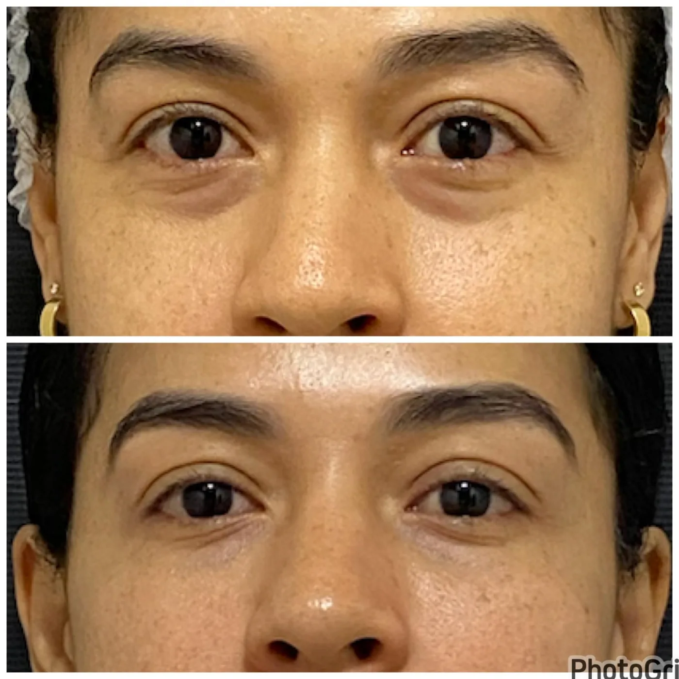 Antes e depois de tratamento de olheiras com preenchimento