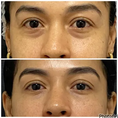 Antes e depois de tratamento de olheiras com preenchimento