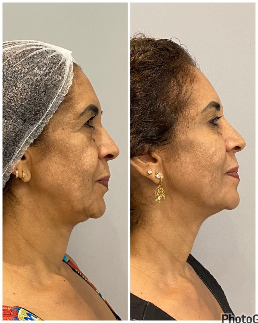 Antes e depois de lifting com fios de PDO para redução de papada pela Dra. Larissa Abreu em Salvador