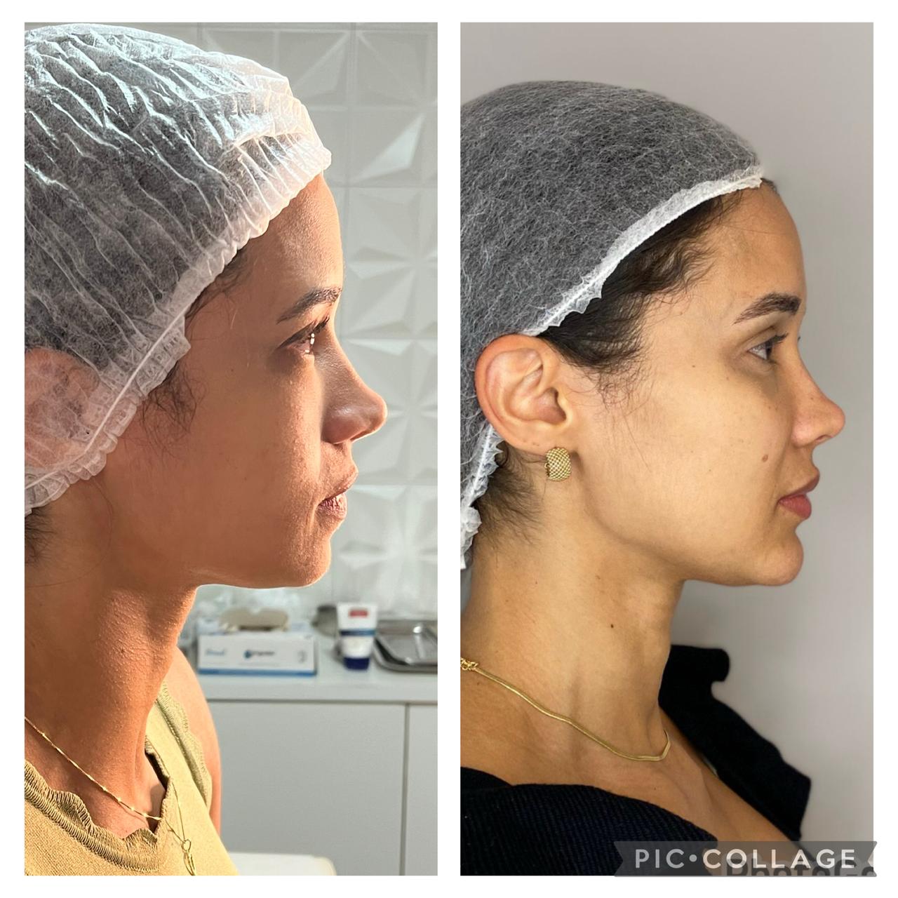 Antes e depois de lifting facial com fios de PDO — perfil lateral