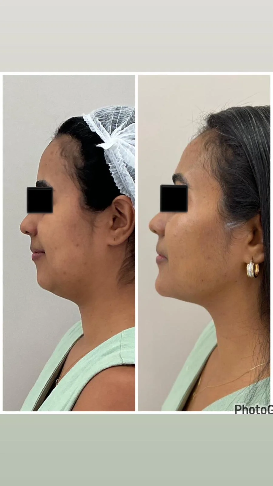 Antes e depois de harmonização facial e papada — vista de perfil