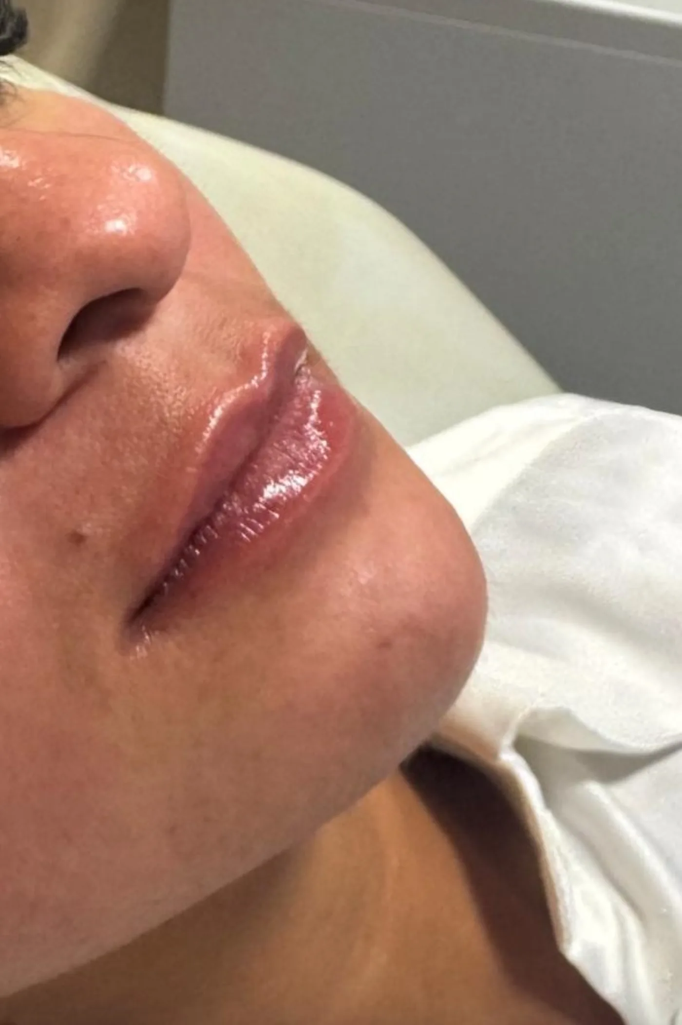 Antes e depois de preenchimento e contorno labial — resultado natural