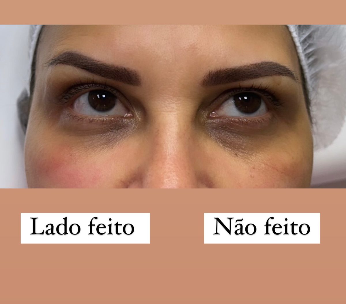 Antes e depois de preenchimento de olheiras em Feira de Santana — paciente da Dra. Larissa Abreu