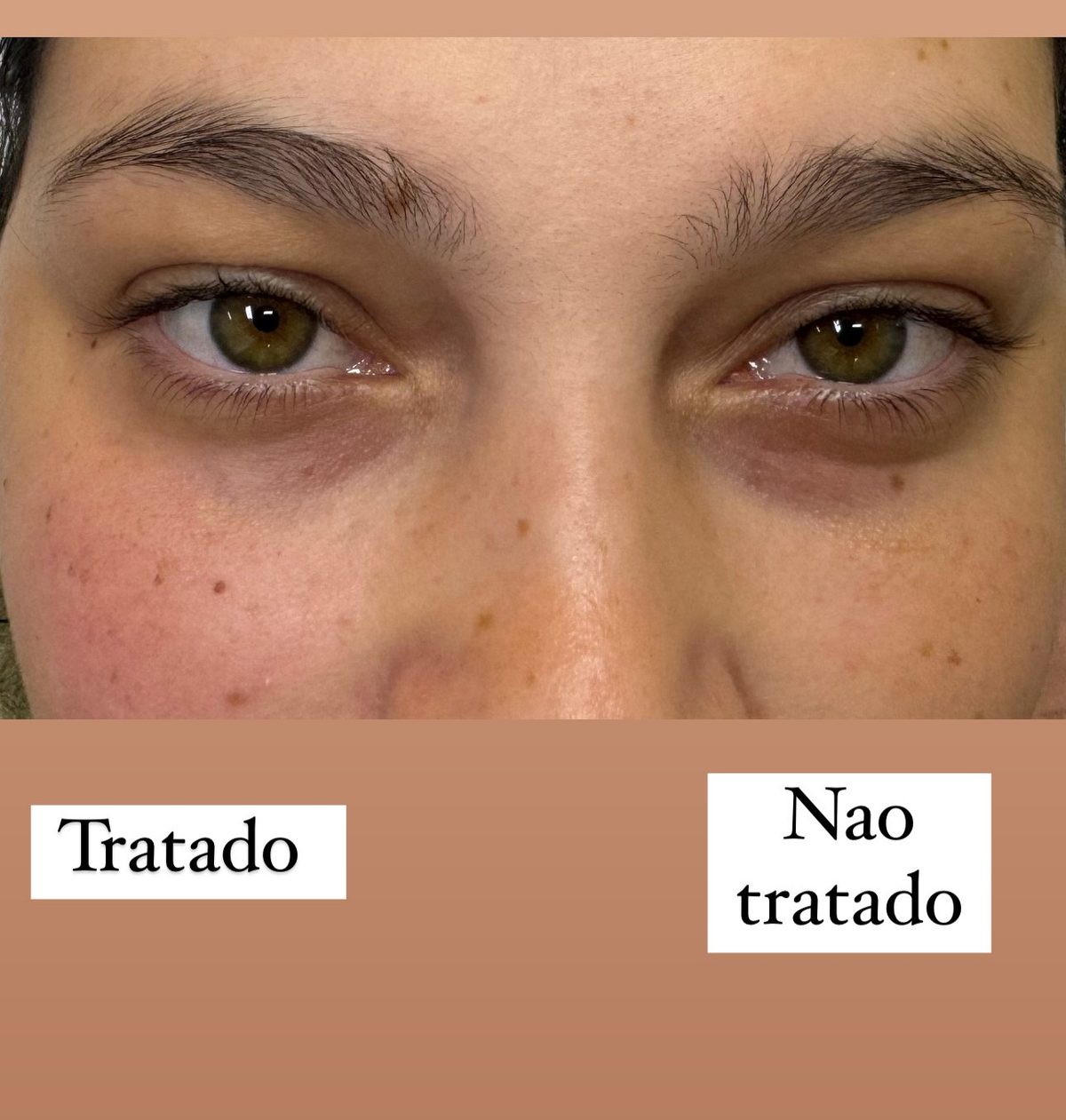 Resultado de preenchimento de olheiras com ácido hialurônico em Feira de Santana — Dra. Larissa Abreu