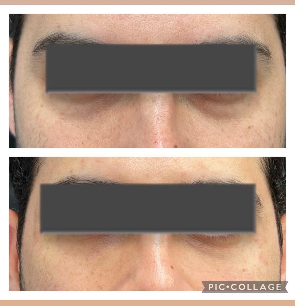 Antes e depois de preenchimento de olheiras em paciente masculino — Dra. Larissa Abreu, Feira de Santana