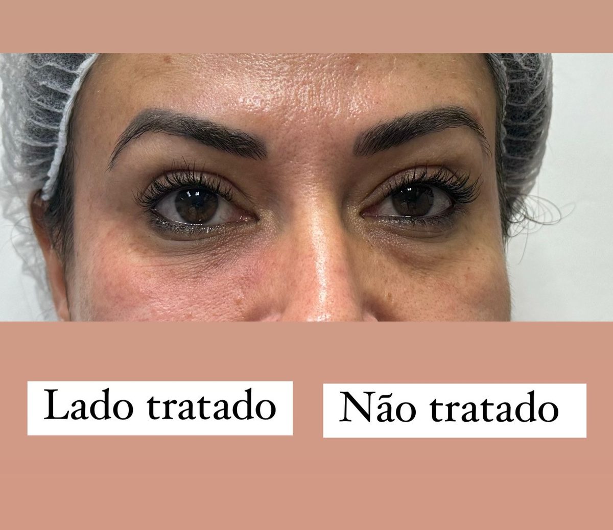 Comparativo lado tratado x não tratado de preenchimento de olheiras — Dra. Larissa Abreu, Feira de Santana